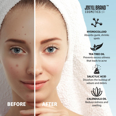 Nose Pore Patch for Pimples, Blemishes & Acne – Hydrocolloid Spot Treatment for Clear, Smooth Skin